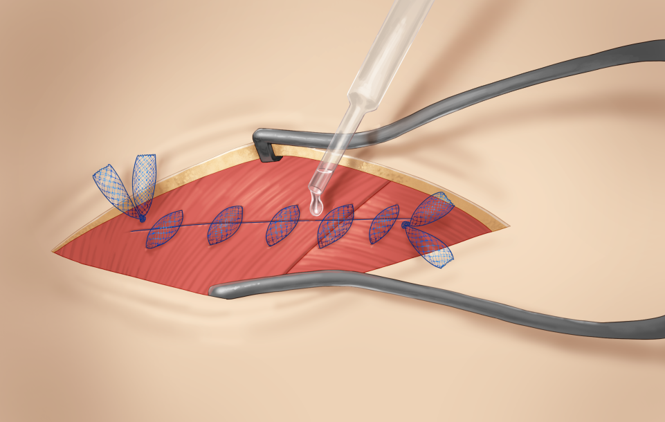 incision4_5.png