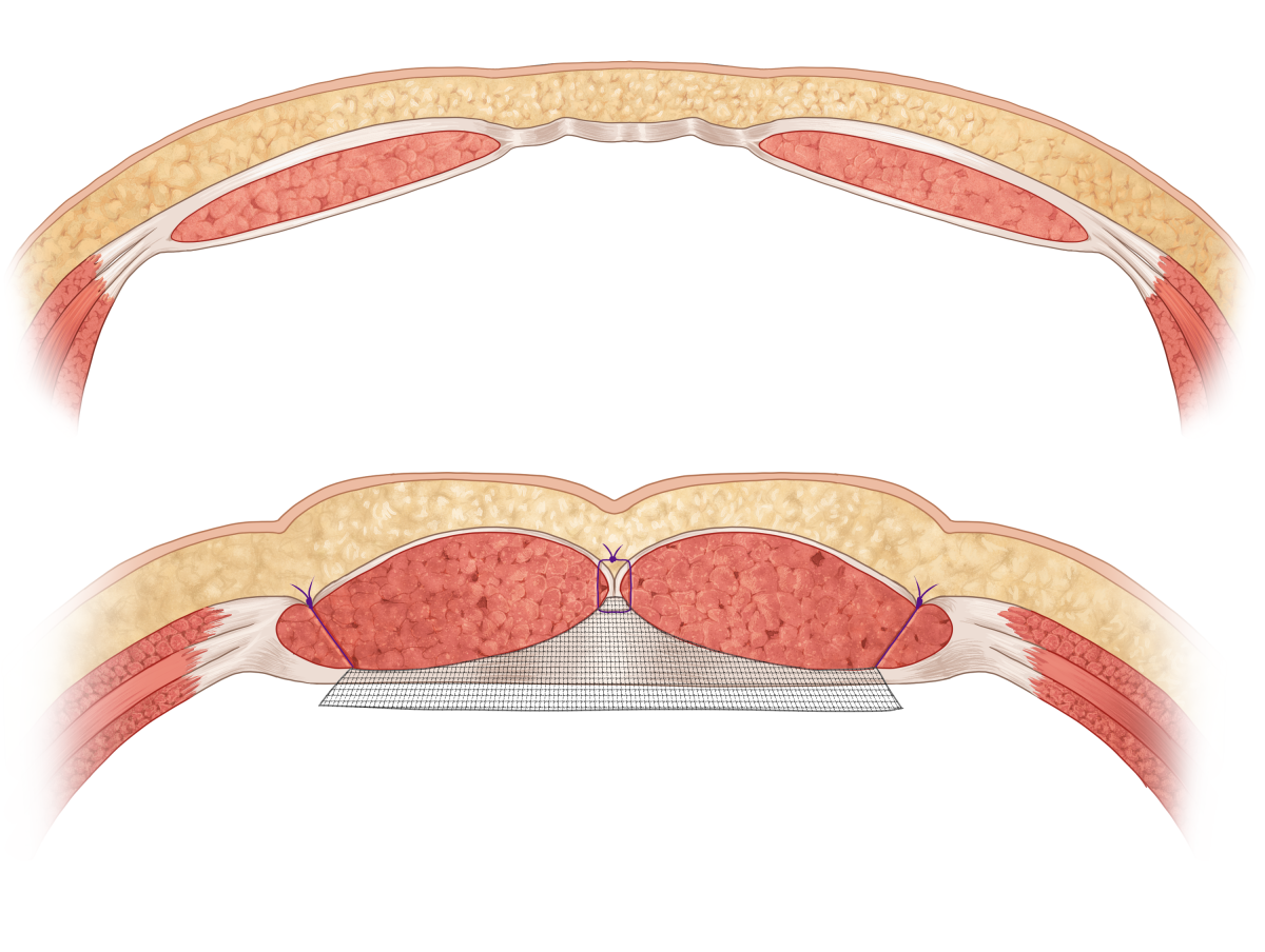 diastasis figure 1 small3.png