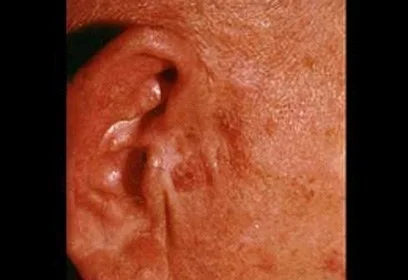 Actinic Keratosis (AK)