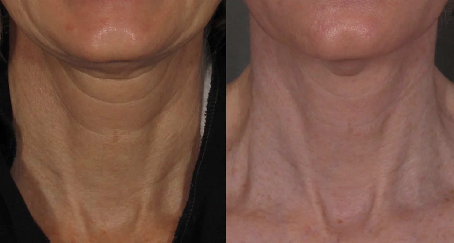 Before and after neck.jpg