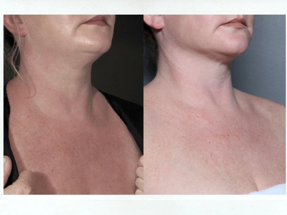 All About The Chest — Dr. Katie Beleznay