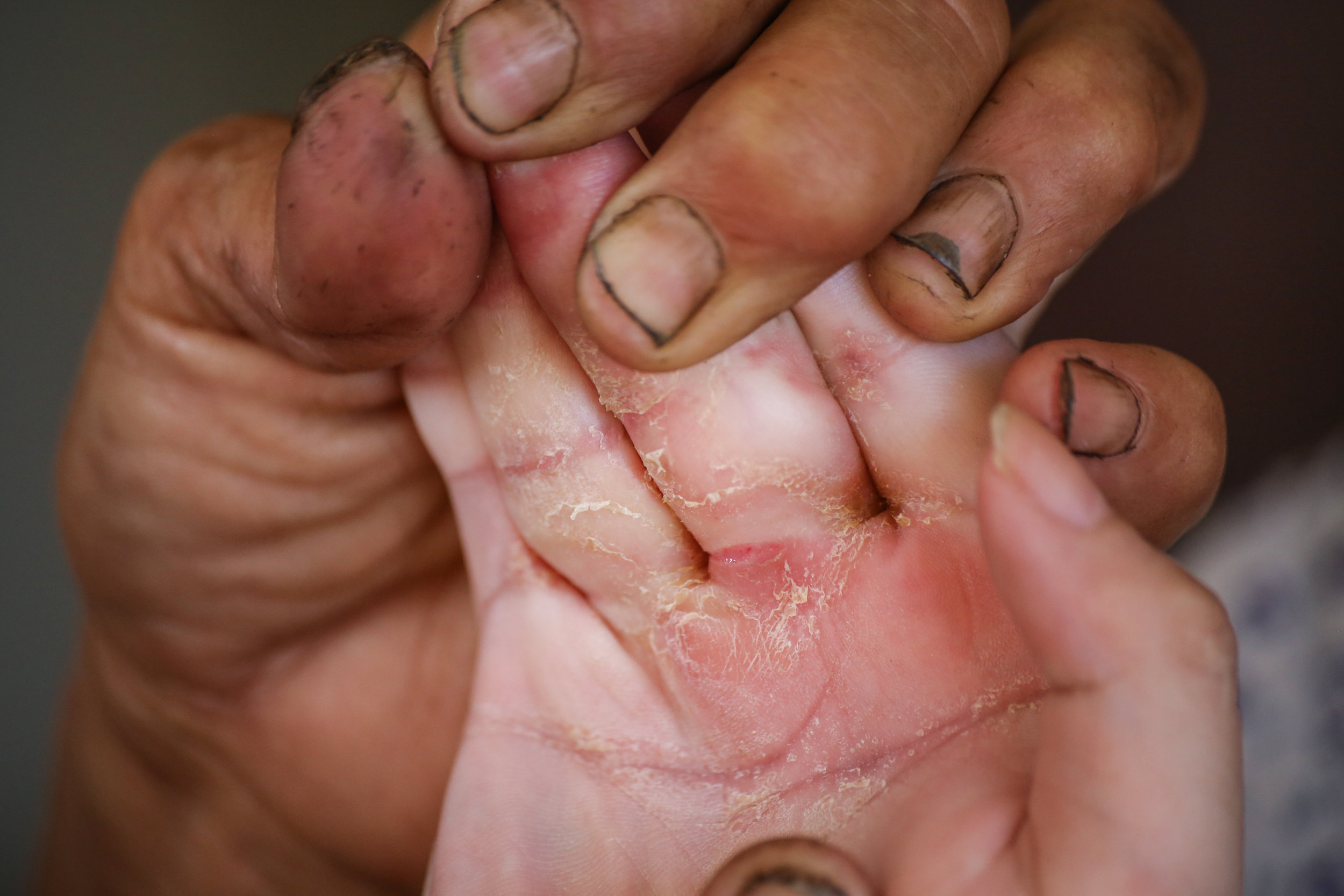 Lien suffers from cerebral palsy which has her gripping her hand to the point in which her nails cut through the skin. August 2nd, 2015.