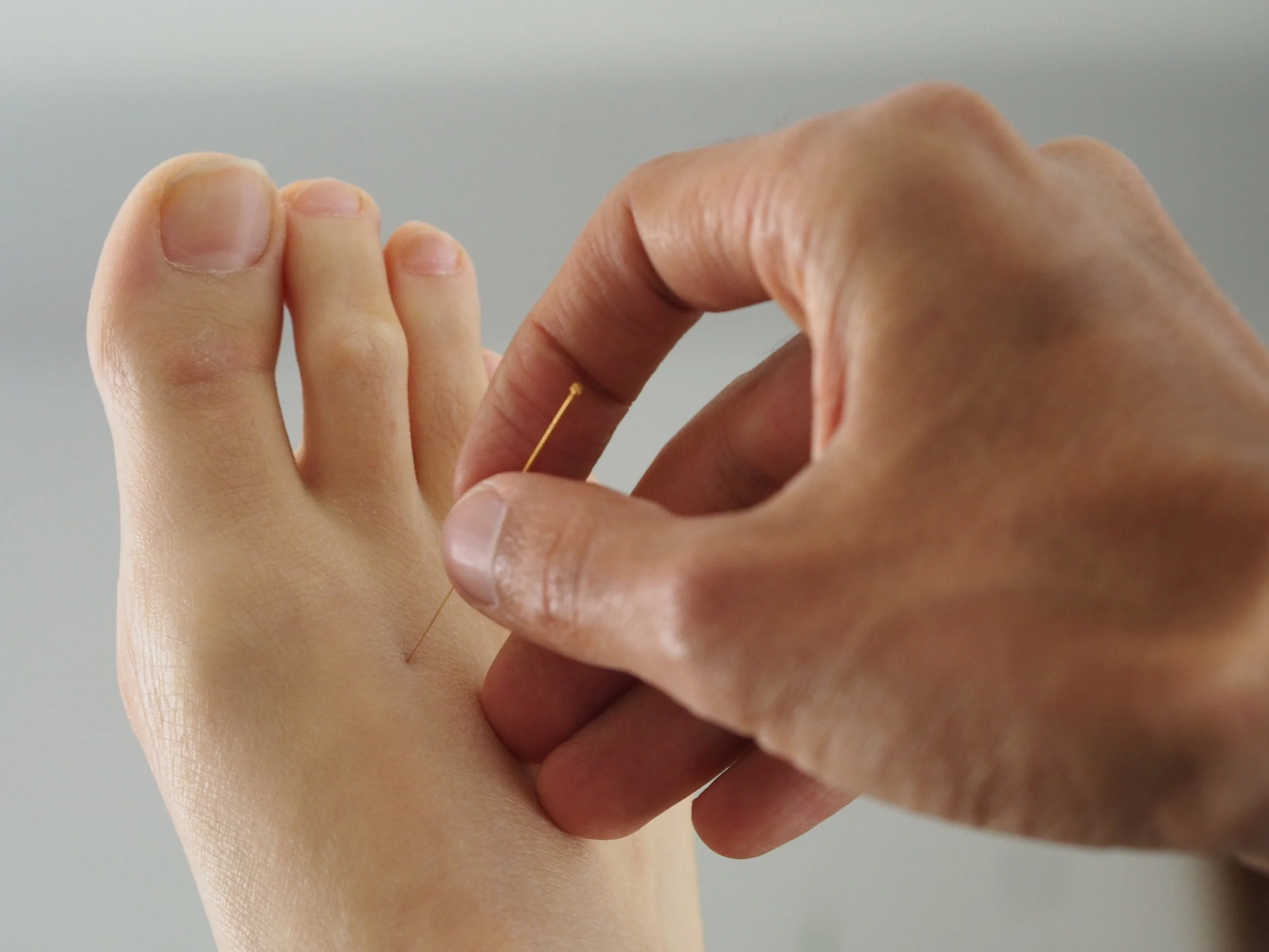 acupuncture.jpg