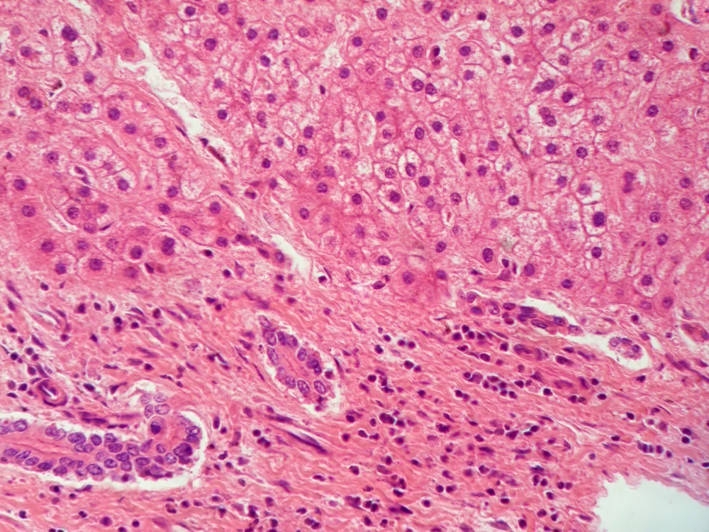 Fighting liver fibrosis, the wound that never heals 