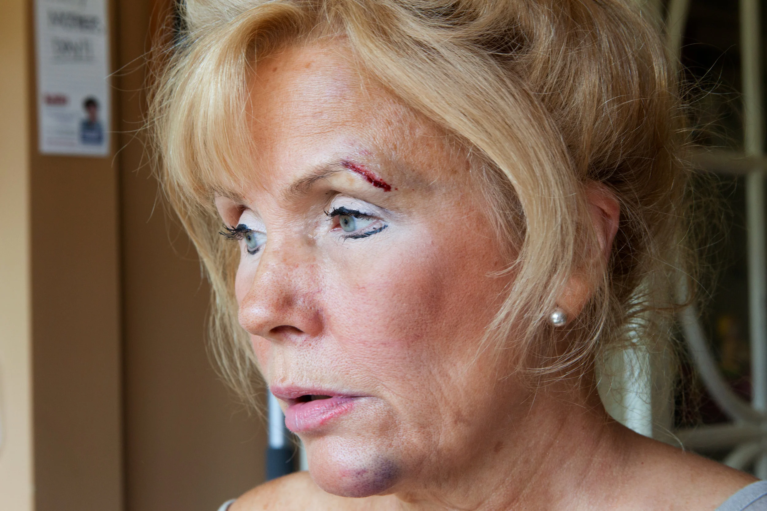 “I fell down and broke my jaw,” 2012