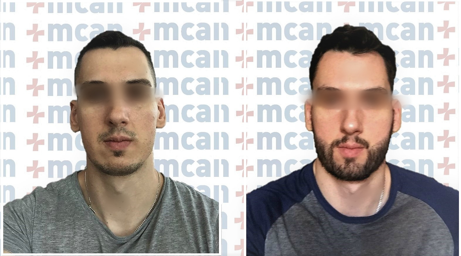 beard transplant before after.jpg