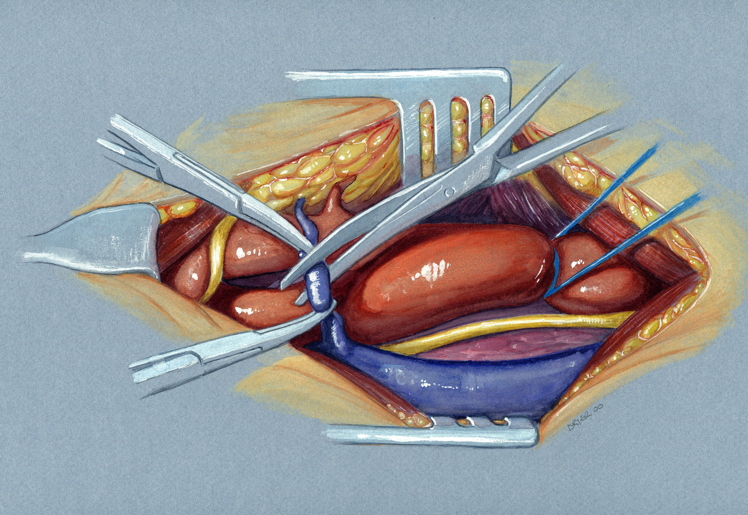 Carotid Endarterectomy Watercolour