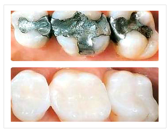 Amalgam (silver colored) fillings (TOP) replaced with Composite Fillings (tooth colored) resulting in a pleasing cosmetic appearance (Bottom) 