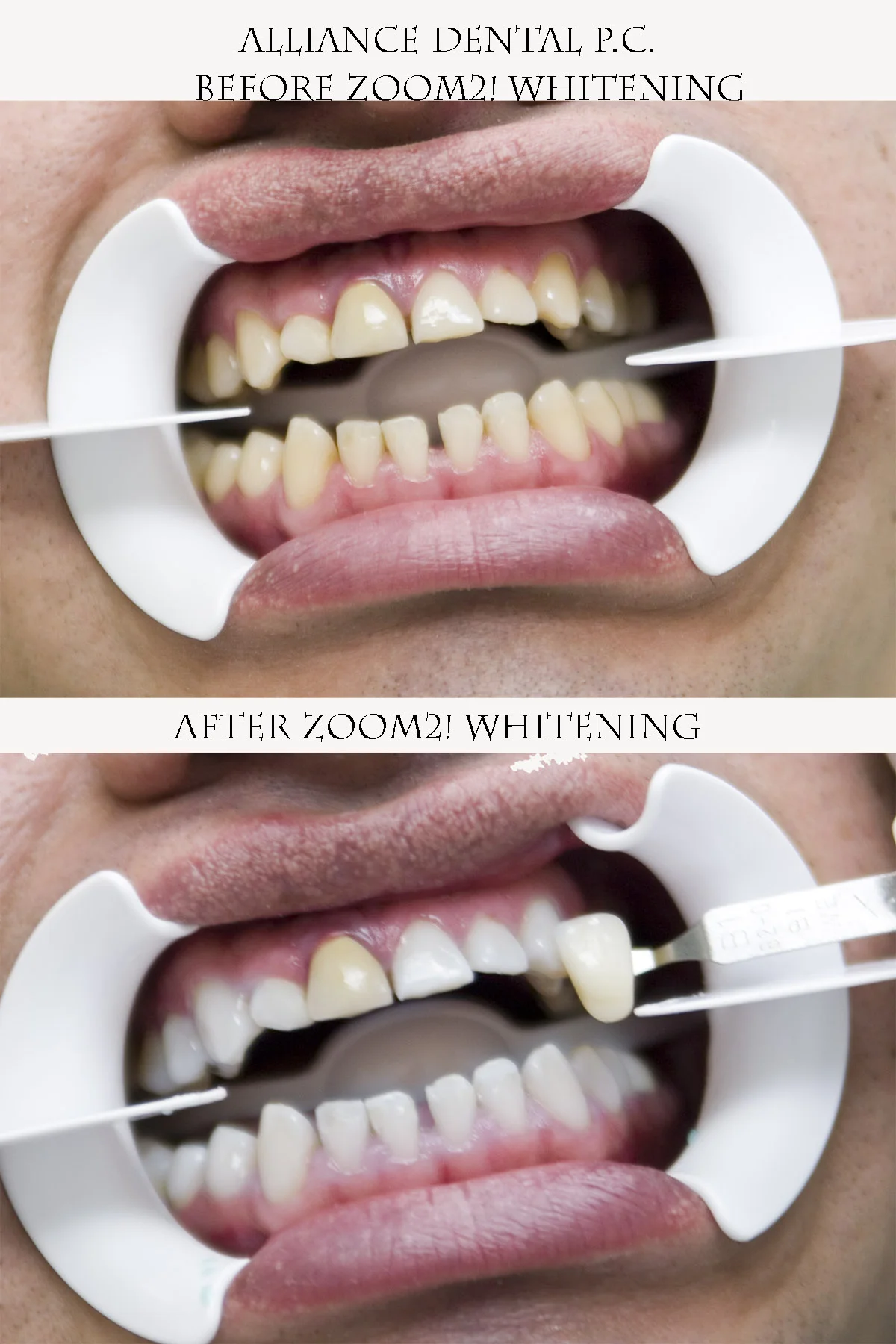 Zoom Professional Dental Teeth Whitening — Alliance Dental Center
