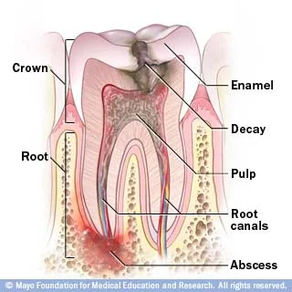 Anatomy of a damaged tooth that requires a Root Canal Treatment