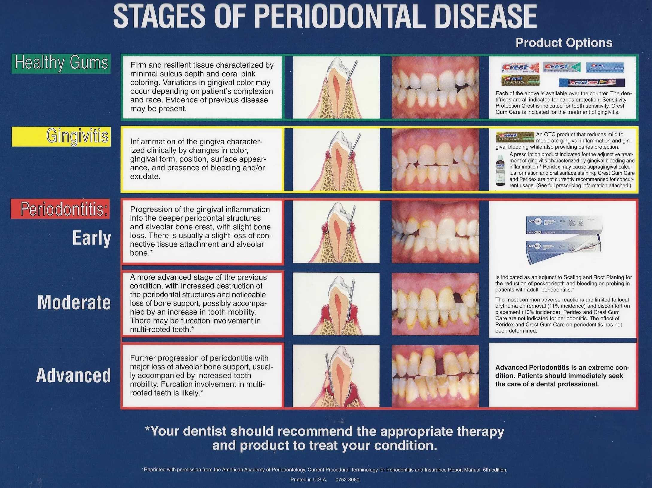 Stages of gum/periodontal disease.
