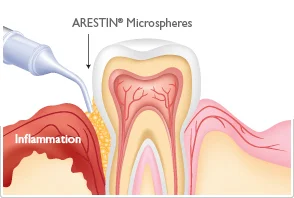 Placement of Arestin antibiotic at the site of periodontal disease