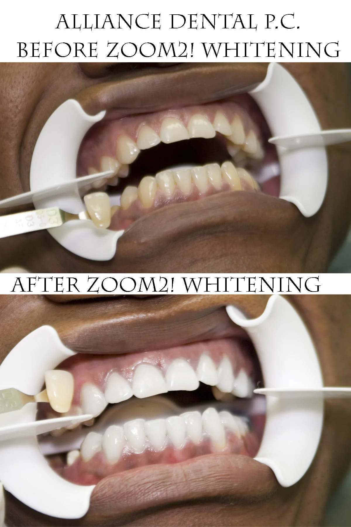 Zoom Advanced Whitening Results at Alliance Dental Center