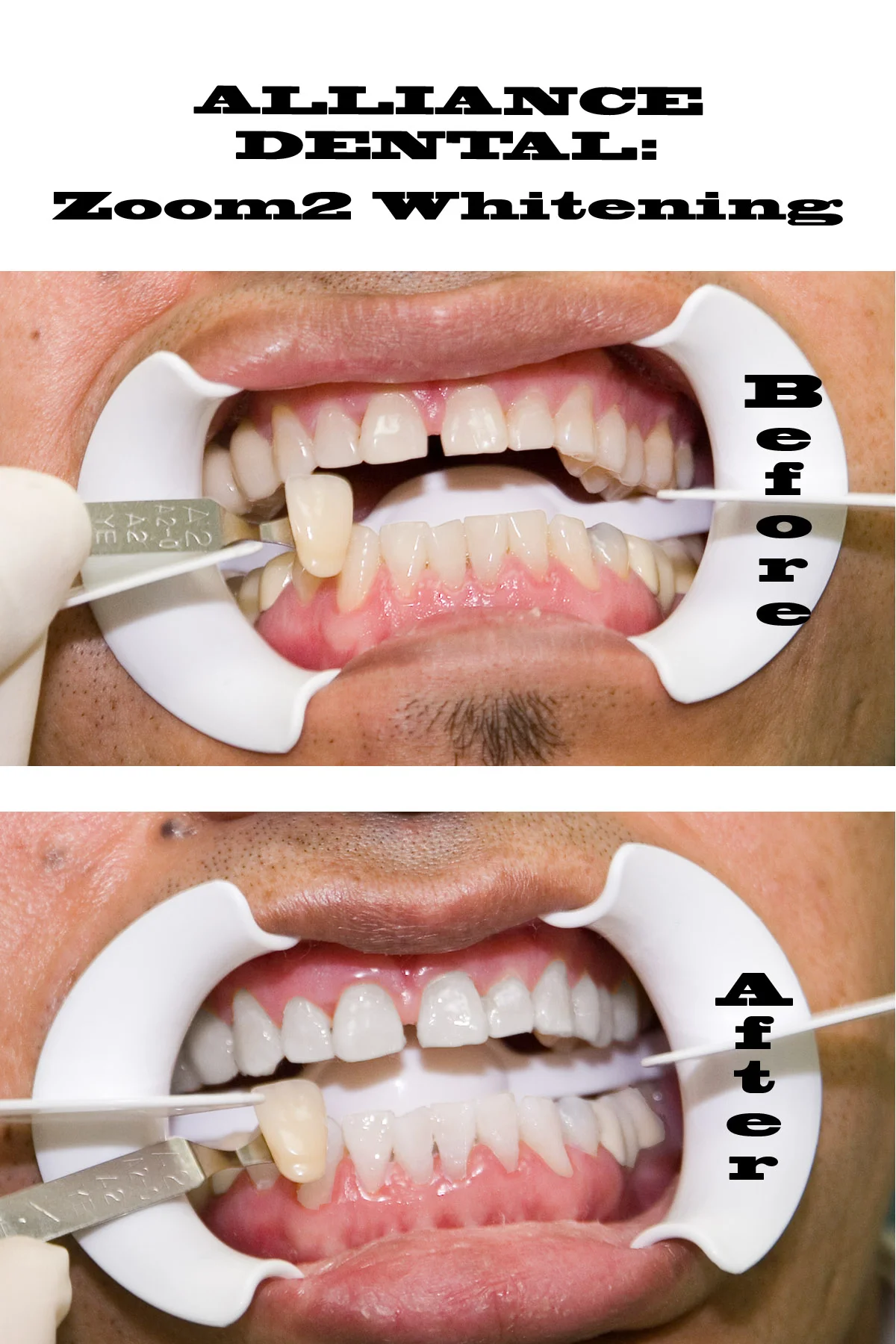 Zoom Advanced Whitening Results at Alliance Dental Center
