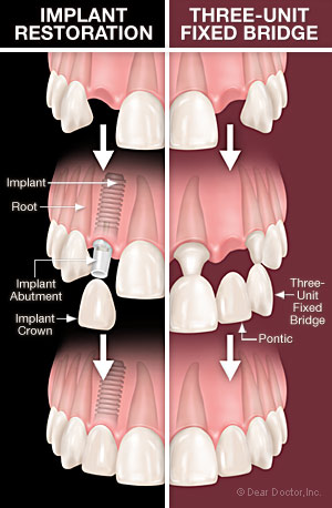 Difference between Implant supported crown and fixed dental bridge