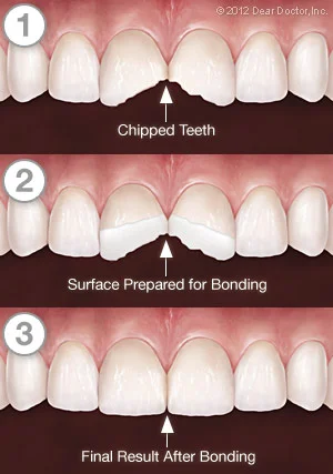 Tooth bonding procedure to repaid minor fracture
