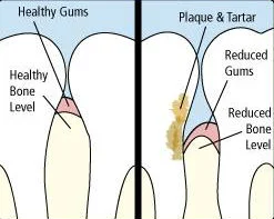 gingivitis.jpg