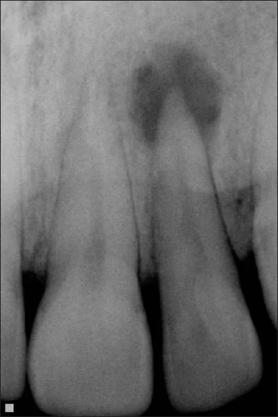 Cysts are not visible to the naked eye, but can be detected via x-ray