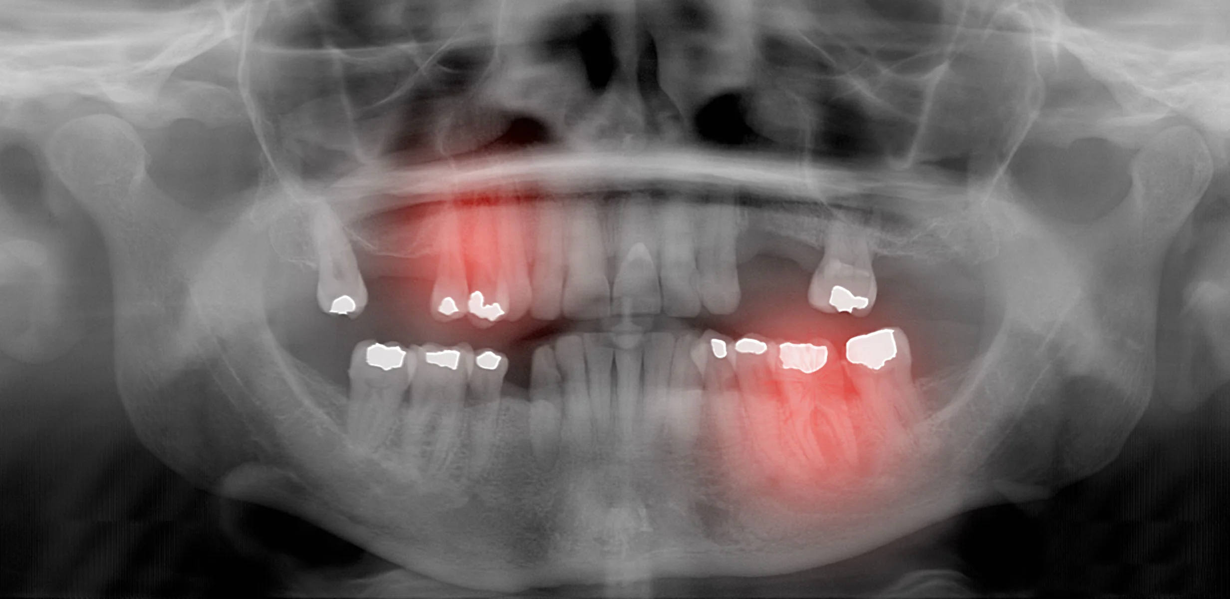 Dental X-rays and why they are necessary