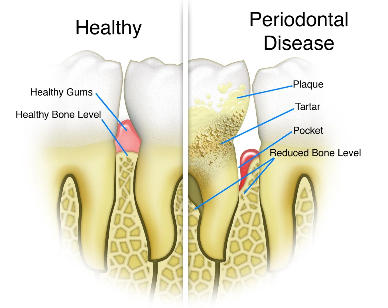 Gum disease affects your general health!