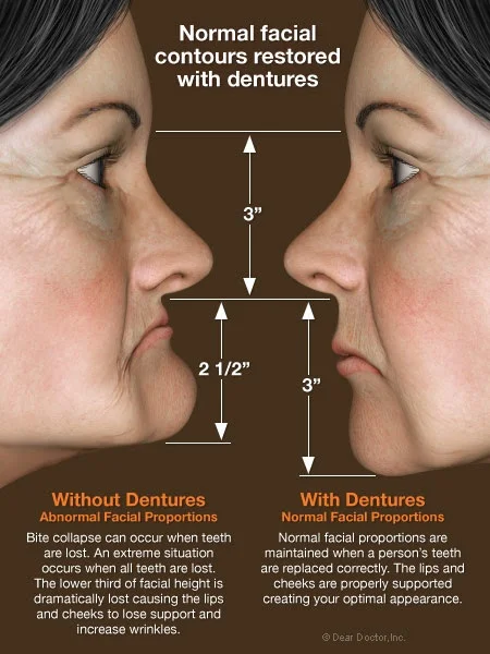 Dentures improve the aesthetics of the face