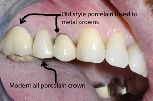 Cosmetic difference between old metal base crowns and new all ceramic crowns