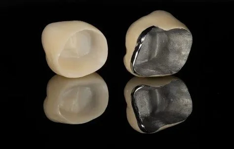 Zirconia crown on the left and PFM Crown on the right