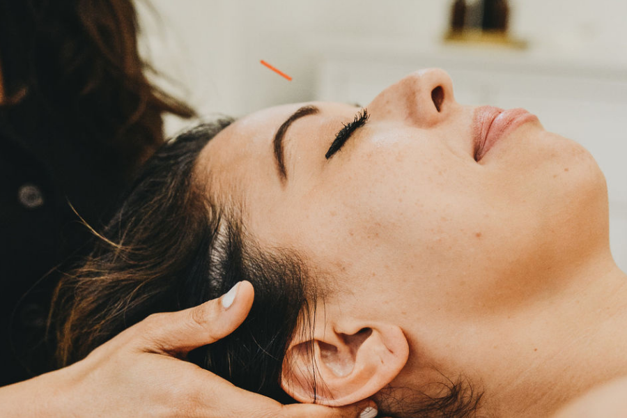 acupuncture for the scalp and brain