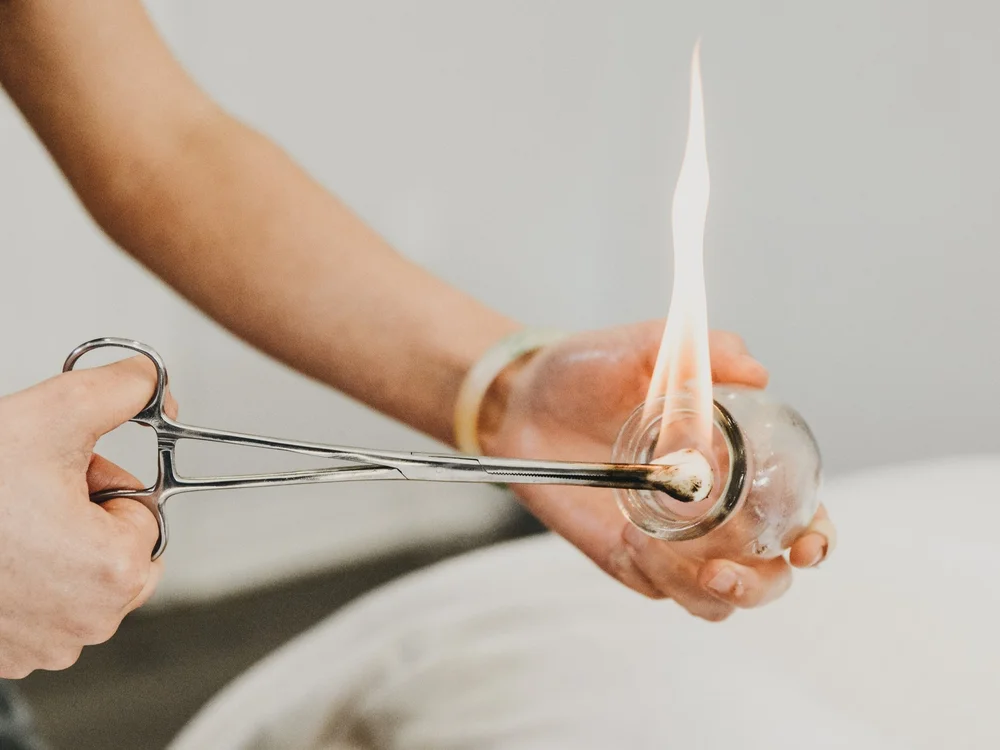 Fire cupping treatment at Saffron & Sage