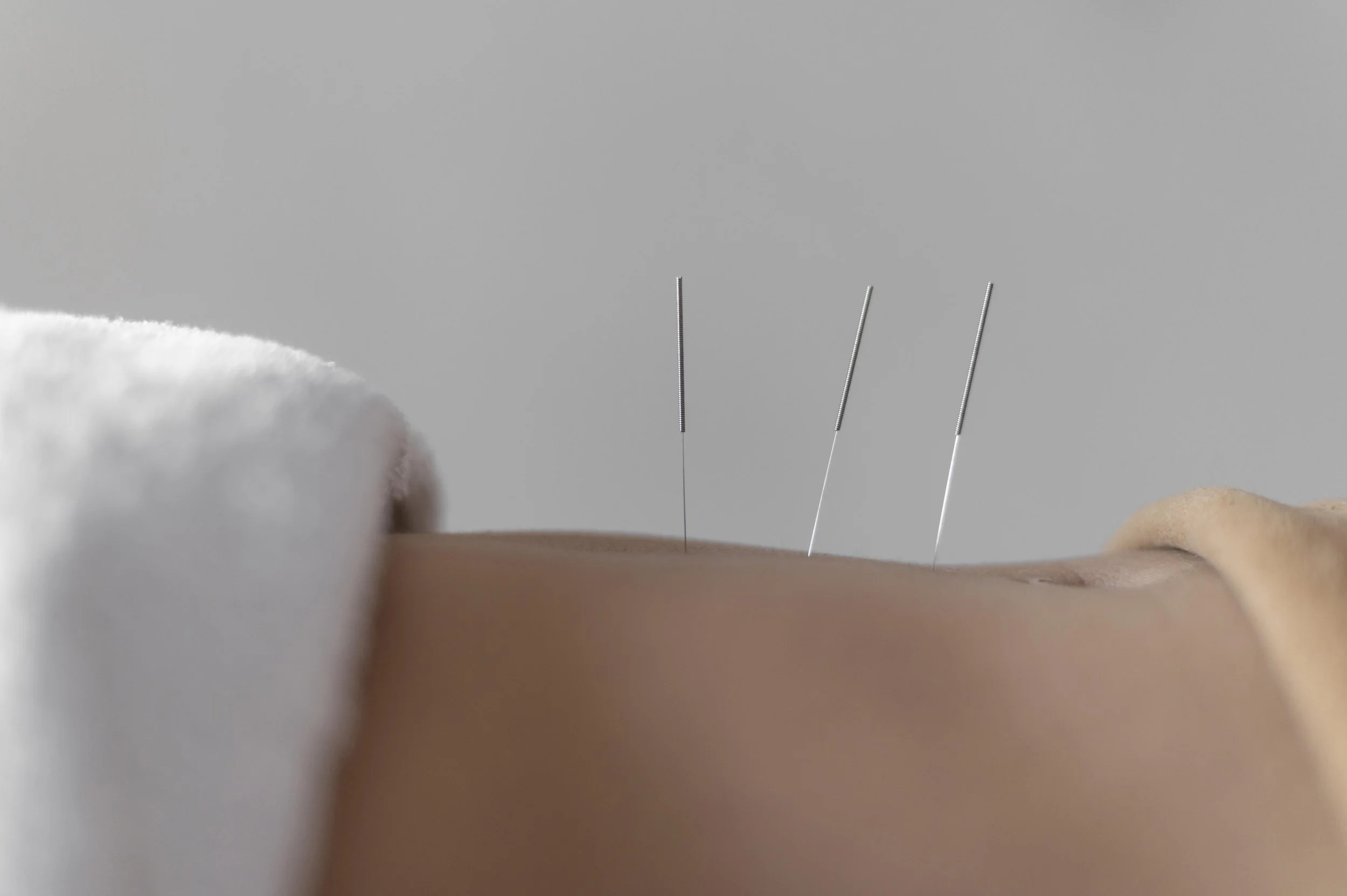 How Prenatal Acupuncture Can Help Manage Anxiety and Mood Swings During Pregnancy
