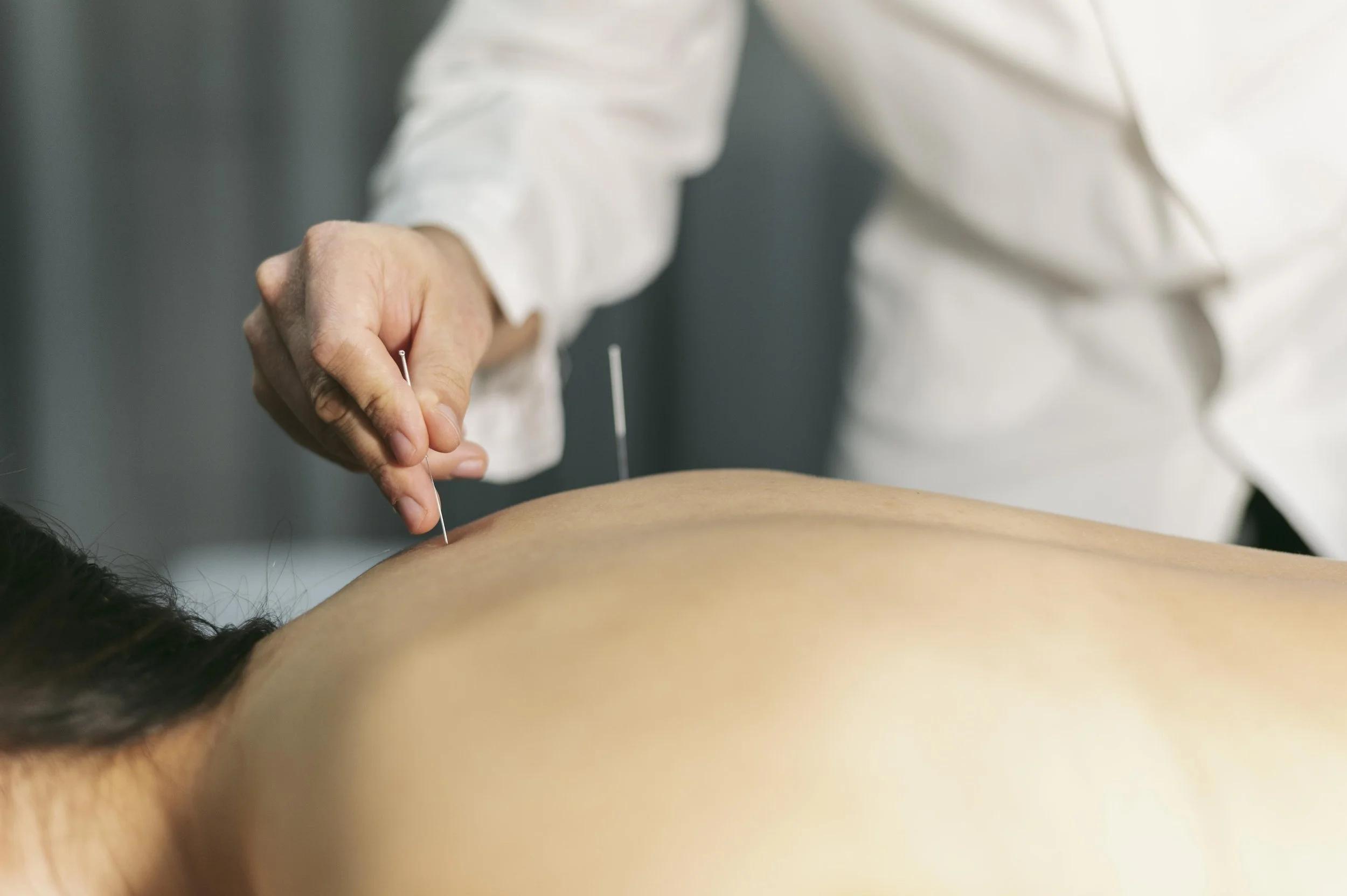 Acupuncture for Stress Relief: A Key Tool for Plaintiff Attorneys in High-Stakes Cases