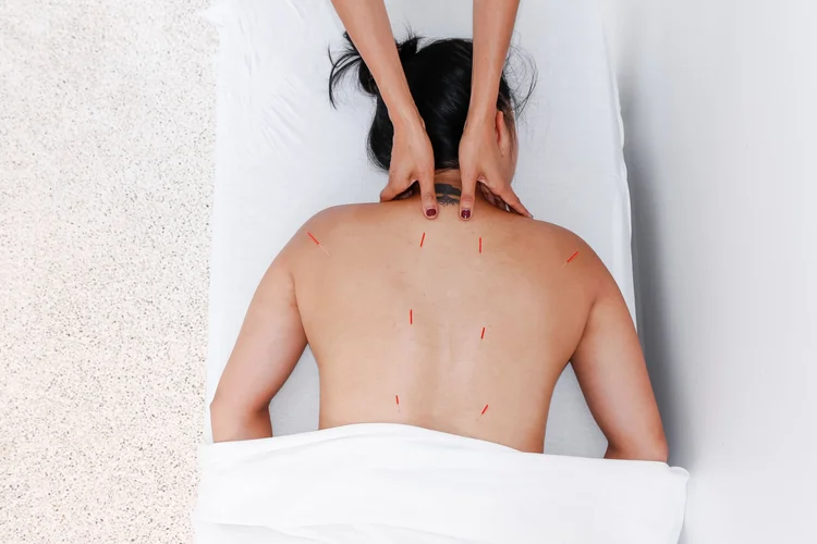 Acupuncture treatment at Saffron & Sage in San Diego