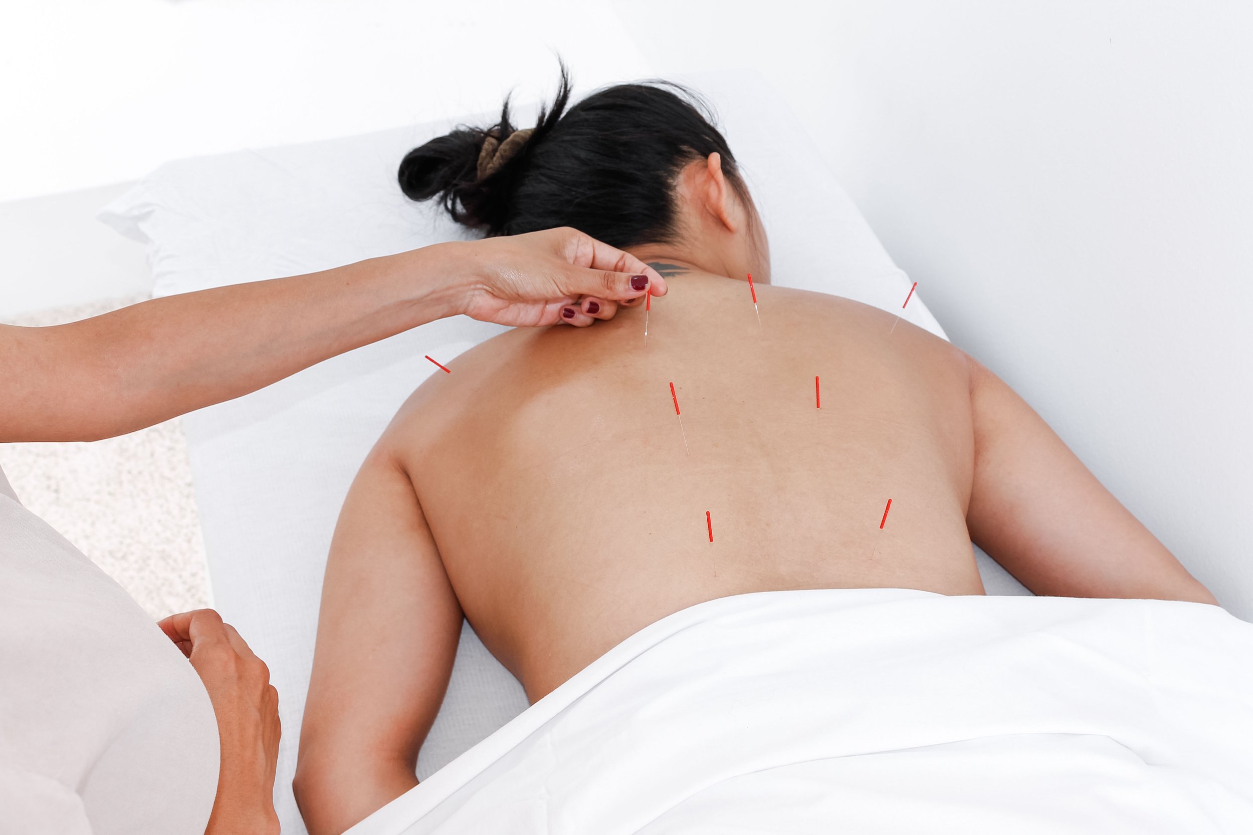 The Acupuncture Edge: What Clinical Research Says About Performance Recovery and Nervous System Optimization