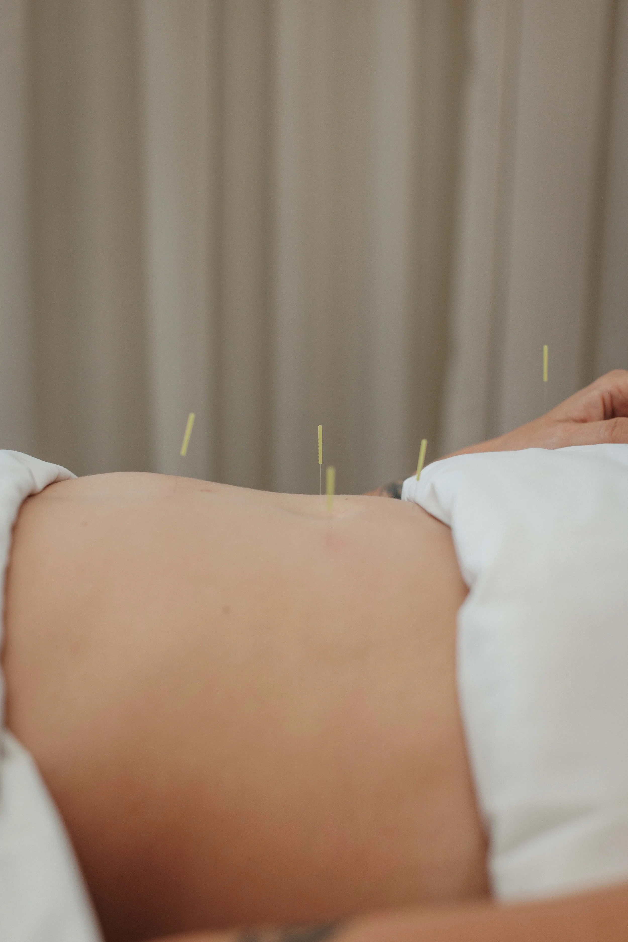 Beyond Fertility: How Acupuncture Supports Ovarian Vitality and Women's Health
