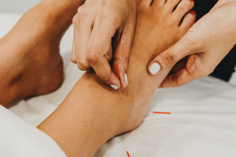 full body acupuncture