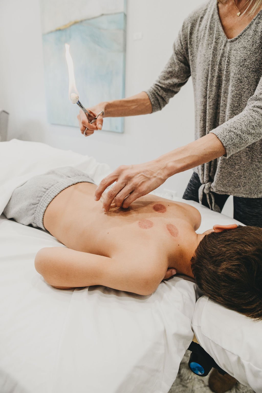 Fire cupping and acupuncture on the back at Saffron & Sage in San Diego