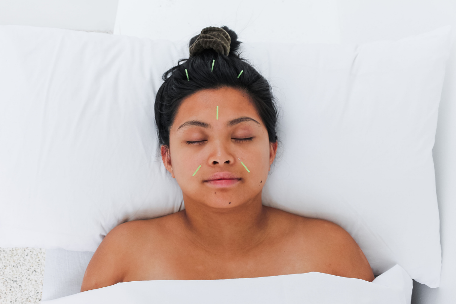 acupuncture for IVF support