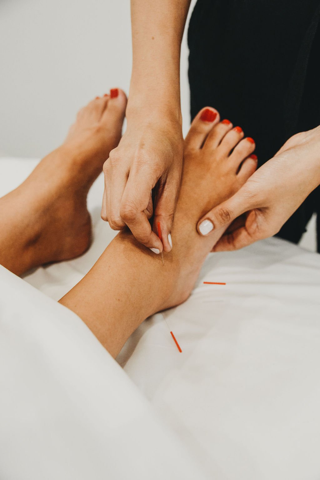 A Doctor of Acupuncture placing fine needles in the foot during a session in San Diego