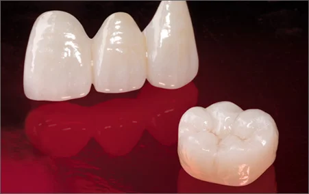 Emax Lithium Disilicate Crowns