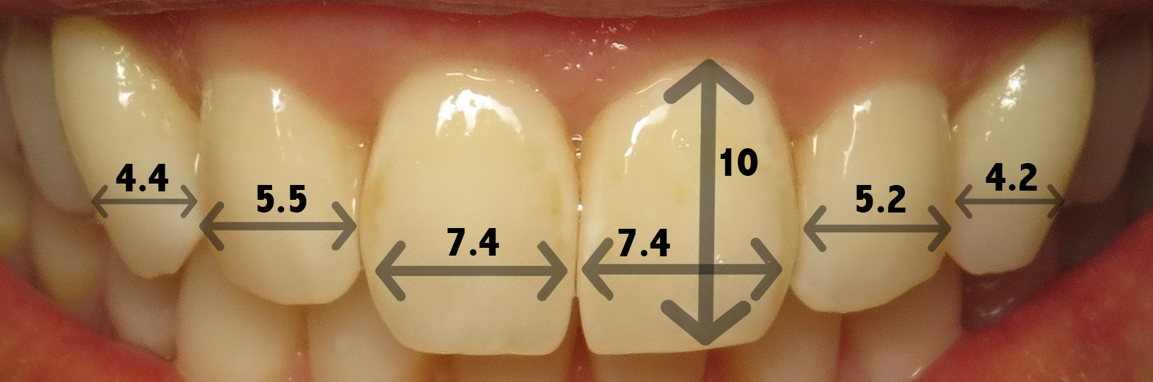 Thousand Oaks Family Dentistry - Golden Proportion Case 1 retracted smile measurements.jpg