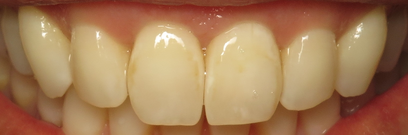 Thousand Oaks Family Dentistry - Golden Proportion Case 1 retracted smile.JPG