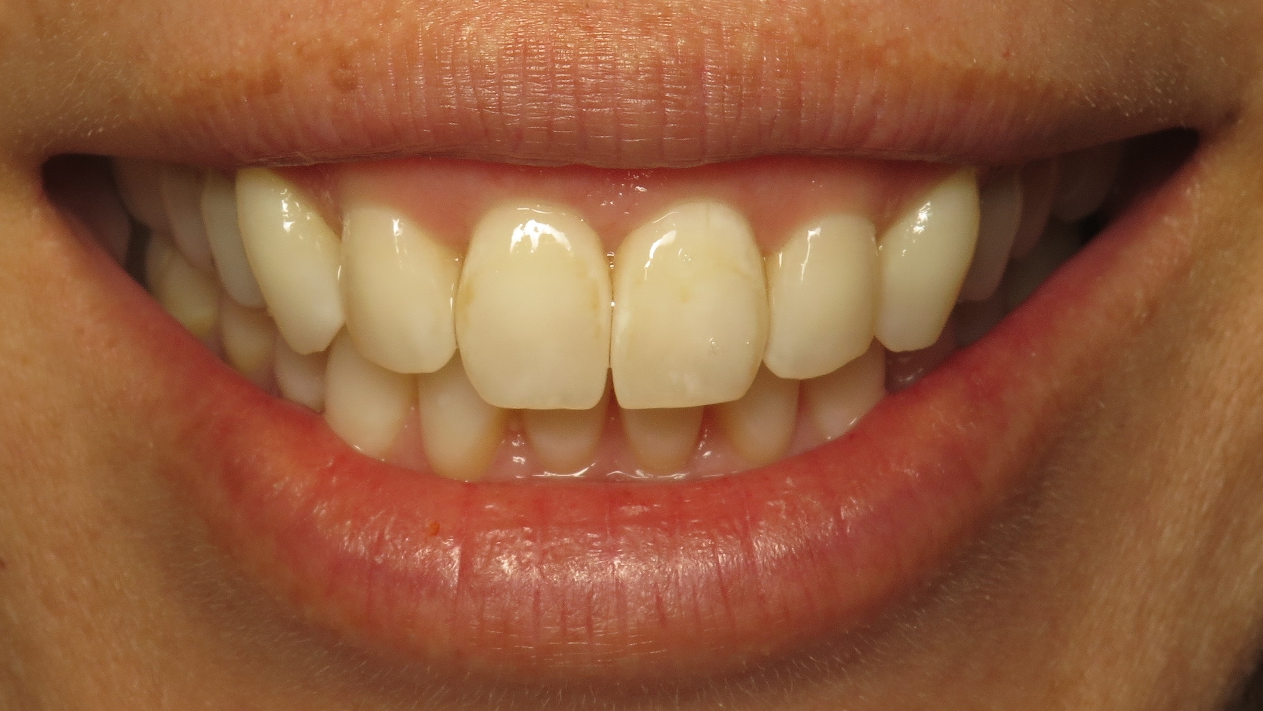 Thousand Oaks Family Dentistry - Golden Proportion Case 1 Lip framed smile.JPG