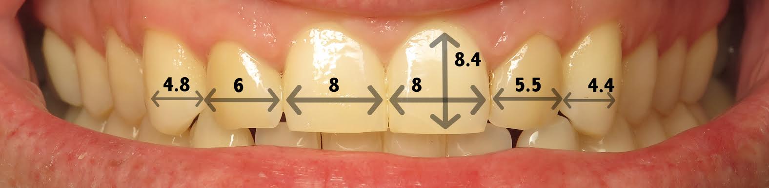 Thousand Oaks Family Dentistry - Golden Proportion Case 2 retracted smile measurements.jpg