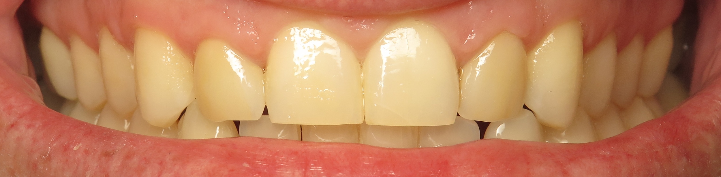 Thousand Oaks Family Dentistry - Golden Proportion Case 2 retracted smile.JPG
