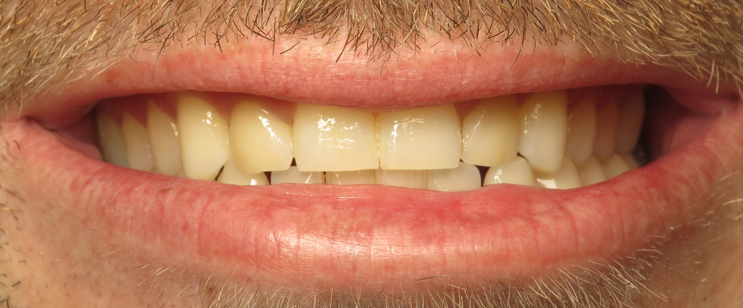 Thousand Oaks Family Dentistry - Golden Proportion Case 2 lip framed smile.JPG