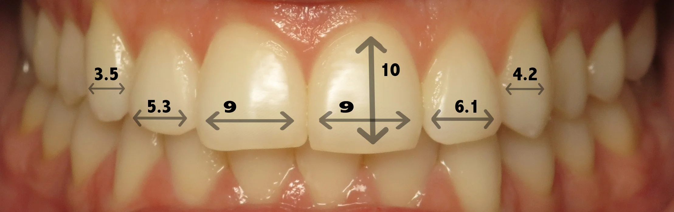 Thousand Oaks Family Dentistry - Golden Proportion Case 3 retracted smile measurements.jpg