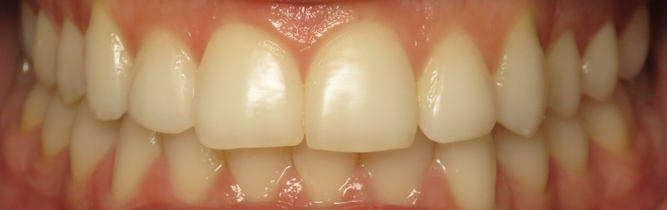 Thousand Oaks Family Dentistry - Golden Proportion Case 3 retracted smile.JPG