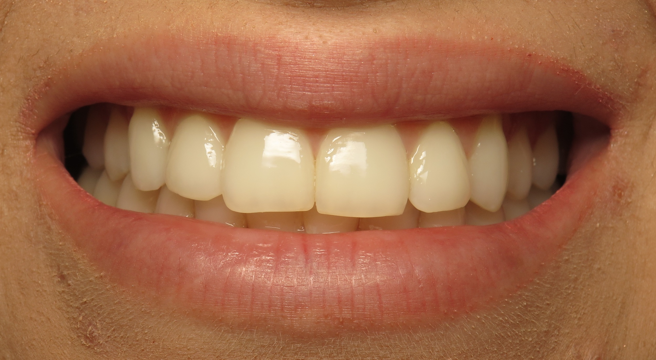 Thousand Oaks Family Dentistry - Golden Proportion Case 3 lip framed smile.JPG