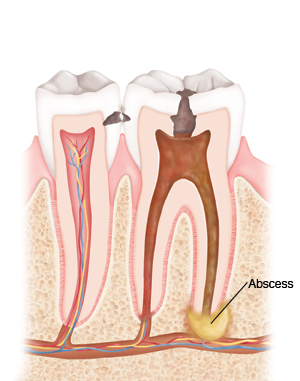 Dental abscesses start small but can have very serious effects.
