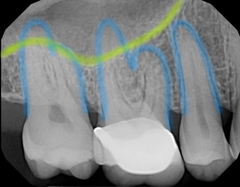 Dental questions: are sinus infections and pain on upper teeth related